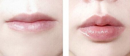 佛山做鼻子手術(shù)哪家醫(yī)院靠譜？