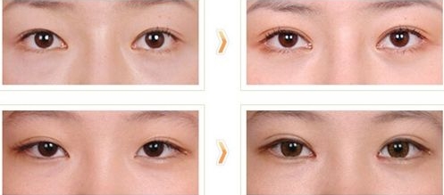 2023南陽(yáng)眼鼻修復(fù)再造大型專家(陳保國(guó)、李穎、黃立新技術(shù)厲害收費(fèi)還不坑)