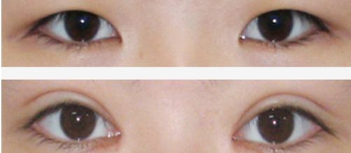 上海祛痘坑的醫(yī)院哪家好？讓你遠(yuǎn)離痘痘困擾的專業(yè)醫(yī)院有哪些？