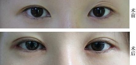 福州抽脂大腿哪家醫(yī)院好？挑選福州最靠譜的抽脂醫(yī)院有哪些？