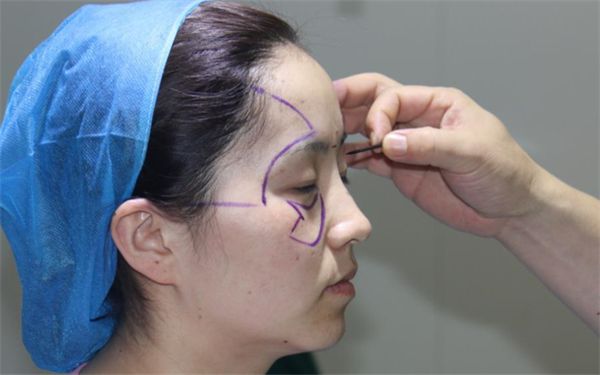 南寧哪家醫(yī)院痘印治療效果最佳？