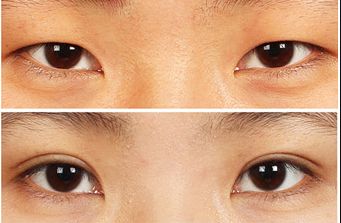 南寧去痘坑哪家醫(yī)院好？揭秘南寧市治療痘坑的頂尖專家團(tuán)隊(duì)！