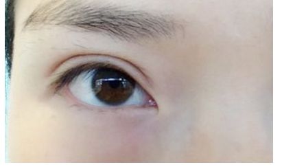 南昌祛痘哪家醫(yī)院口碑好，效果最佳？