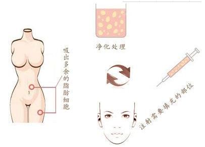 廣州燒傷疤痕治療哪家醫(yī)院效果好，選擇哪家醫(yī)院最靠譜？