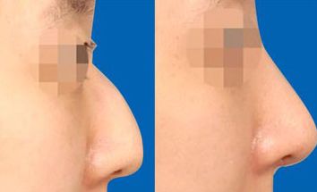 南京鼻綜合修復(fù)醫(yī)院哪家好？找準(zhǔn)南京鼻部整形中心，為你解答！