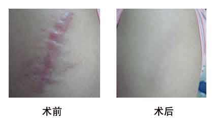 2023寧波口周紋激光去除強榜前10名的醫(yī)生(盧仁鎬、李永俊、陳樂琴正規(guī)良心推薦)