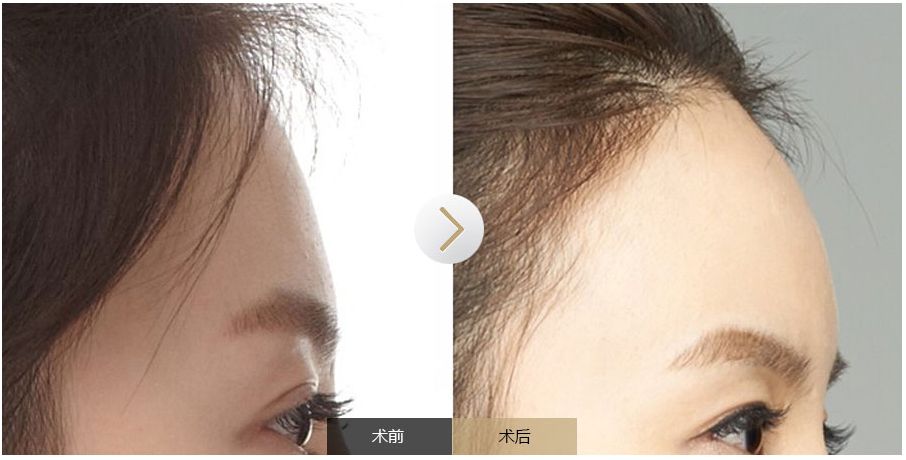 南寧點痣需求旺盛，哪家醫(yī)院是最受歡迎的？