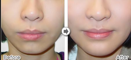 上海做雙眼皮哪家好醫(yī)院？專家評(píng)選2023年最佳雙眼皮醫(yī)院