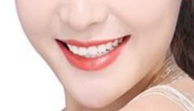 2023廈門電動負(fù)壓吸脂去雙下巴專家前10榜單(袁靜明、周璟、張俠網(wǎng)友親測好評名單分享！)