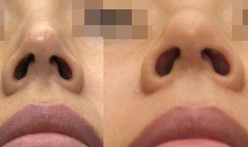 靳小雷雙眼皮修復(fù)手術(shù)的完美案例分享，期待您的見(jiàn)證