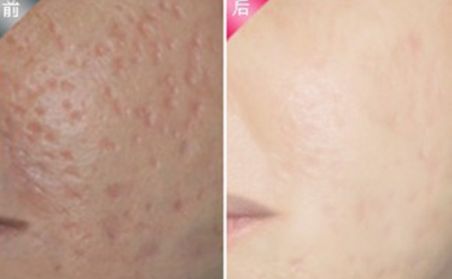 杭州做雙眼皮哪家好？2023年杭州雙眼皮整形醫(yī)院綜合排名指南拆解