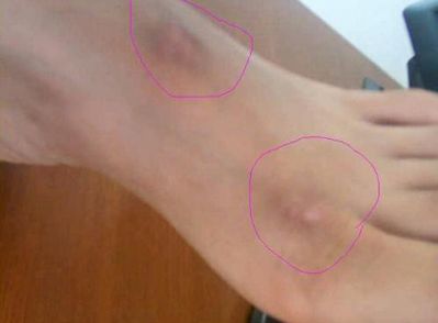 溫州哪家醫(yī)院做雙眼皮手術(shù)好？