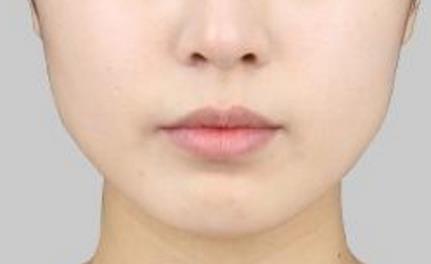 2023甘肅鼻背寬矯正術(shù)強榜前十的醫(yī)生(歷國媛、劉俊玲、陳志芳口碑出色)