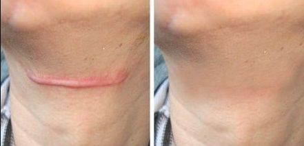 杭州市疤痕醫(yī)院哪家好？無痕祛疤，專業(yè)技術(shù)讓你恢復(fù)自信！