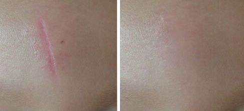 西安雙眼皮手術(shù)最佳推薦，哪家醫(yī)院技術(shù)好？