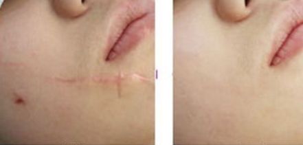 福州激光祛色斑哪家好？了解福州激光祛斑的優(yōu)秀機構(gòu)推薦！