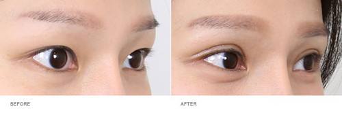 上海整容醫(yī)生推薦：讓您擁有完美鼻型，變身肋骨鼻！