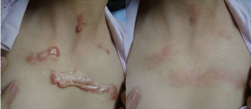 廣州市治療疤痕效果好的醫(yī)院有哪些？