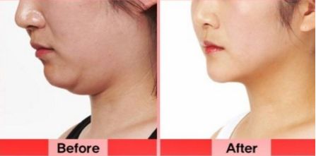 洛陽雙眼皮修復(fù)哪家好？挑選專業(yè)技術(shù)實(shí)力強(qiáng)的醫(yī)療機(jī)構(gòu)