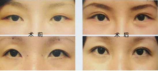 揭秘佛山哪家整形醫(yī)院吸脂好？導(dǎo)醫(yī)全解析、患者口碑高，信賴度高！