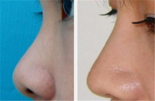 2023成都活細胞去法令紋專家評價前10名(丁紅梅、王平、楊平風(fēng)格特色價格不同~)