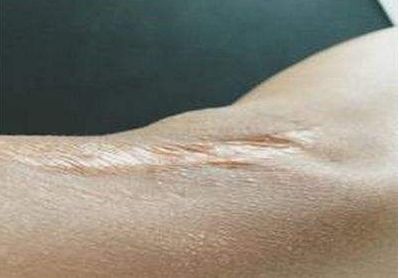 深圳治痘坑哪家醫(yī)院好？推薦有口碑的專業(yè)去痘項(xiàng)目醫(yī)院