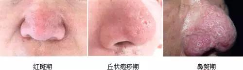 解密楊杰雙眼皮修復(fù)失敗案例圖，讓你心中的期望成為現(xiàn)實！