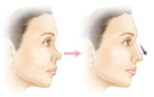 長沙美萊潘衛(wèi)峰做脂肪填充效果如何？醫(yī)生經(jīng)驗口碑詳細了解！