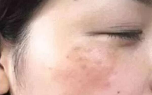 武漢協(xié)和醫(yī)院醫(yī)生鐘愛(ài)梅，精湛鼻子整形案例揭秘