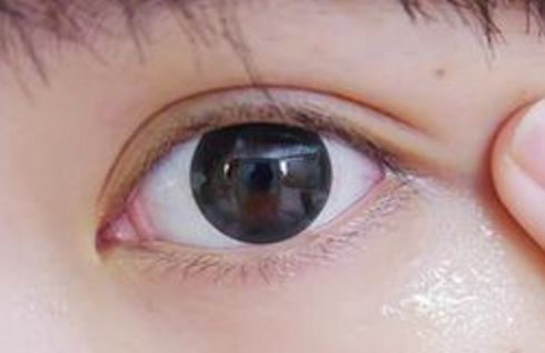 山東割眼袋哪家醫(yī)院好？眼袋手術(shù)山東醫(yī)院哪家專業(yè)靠譜？