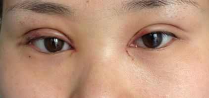 沈陽哪家醫(yī)院疤痕手術效果好？