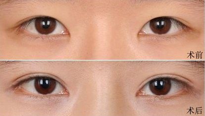 大連假體隆鼻哪家醫(yī)院好？打造完美鼻型，這家醫(yī)院是最佳選擇！