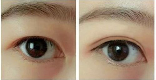 揭秘！哈爾濱哪家醫(yī)院的隆鼻手術效果最好推薦