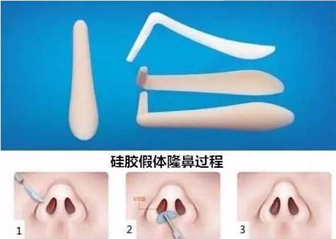 北京哪家醫(yī)院祛除眼袋效果最好？