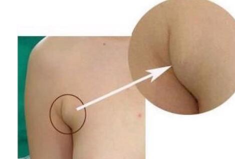 張誠教授為您的雙眼皮修復提供完美解決方案！成功案例分享，糾正雙眼皮失敗的救星~