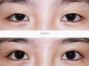 昆明哪家醫(yī)院的隆鼻整形效果好？