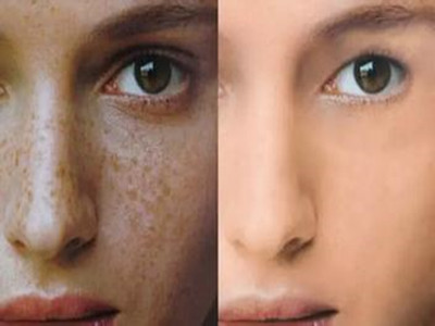 2023北京光子去雀斑排行榜前10名的醫(yī)生(武崇高、王凱瀠、邢志花在榜內(nèi))