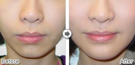 武漢熱瑪吉技術(shù)治療最好的醫(yī)院是哪家？