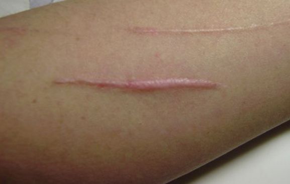 深圳哪家醫(yī)院的取膨體效果最好？