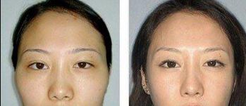 重慶去眼袋哪家醫(yī)院好？選擇靠譜的醫(yī)療機(jī)構(gòu)，功效更可靠！