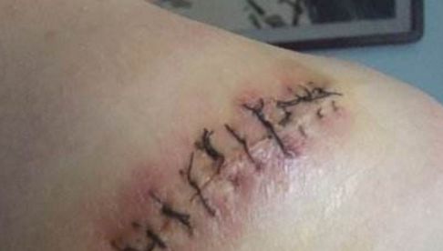 信陽哪家醫(yī)院祛痘效果好，專家推薦去哪家醫(yī)院治療痘痘？