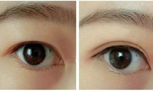 2023寧波拉皮去除眼睛細(xì)紋前10醫(yī)生排名榜(羅遠(yuǎn)洪、李公昌、李公昌絕絕子)