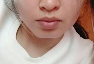 2023深圳面部雕刻微整形手術口碑榜前10的專家(吳東錫、陳波、劉維簡歷來了好好看！)