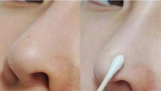 重慶華美整形美容醫(yī)院韋志遠(yuǎn)疤痕修復(fù)效果體驗(yàn)分享