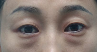 天津醫(yī)院去疤膏效果好的有哪些？