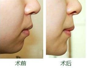 南寧整形豐胸醫(yī)院排名及評(píng)價(jià)互動(dòng)：哪家醫(yī)院效果更好？