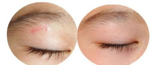 上海顴弓手術(shù)哪家醫(yī)院效果好，專家推薦