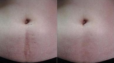 【大連市激光袪疤治療排名】哪家醫(yī)院激光袪疤好？