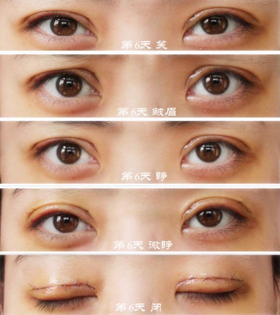 武漢哪家醫(yī)院做眼袋手術好又專業(yè)有效