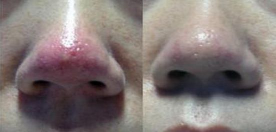 2023年浙江地區(qū)雙眼皮手術(shù)哪家醫(yī)院好，專屬權(quán)威排行榜